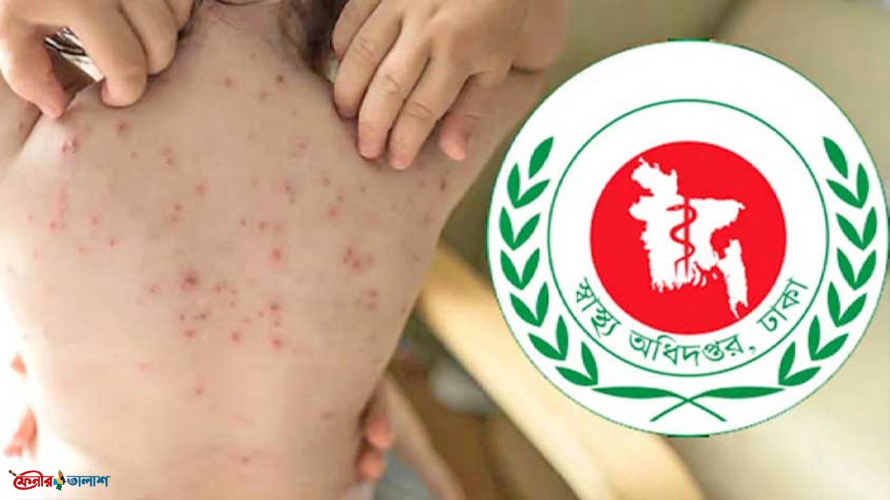 হামের উপসর্গে আরো ৬ শিশুর মৃত্যু হয়েছে